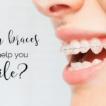 4 Steps To Choose the Right Braces for Your Smile